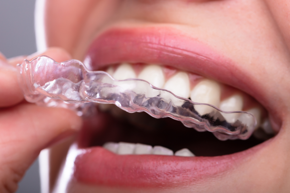 invisible braces: how to straighten your teeth using clear aligners