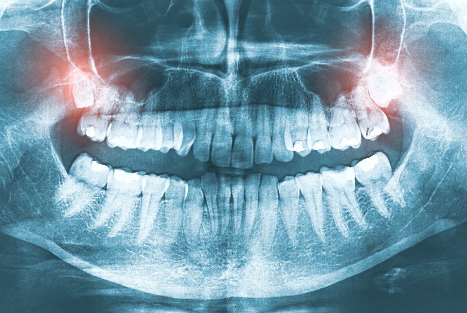 Tooth Alignment Change After Wisdom Tooth Extraction