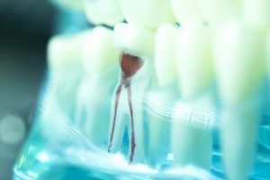 What Is Root Canal Treatment xray